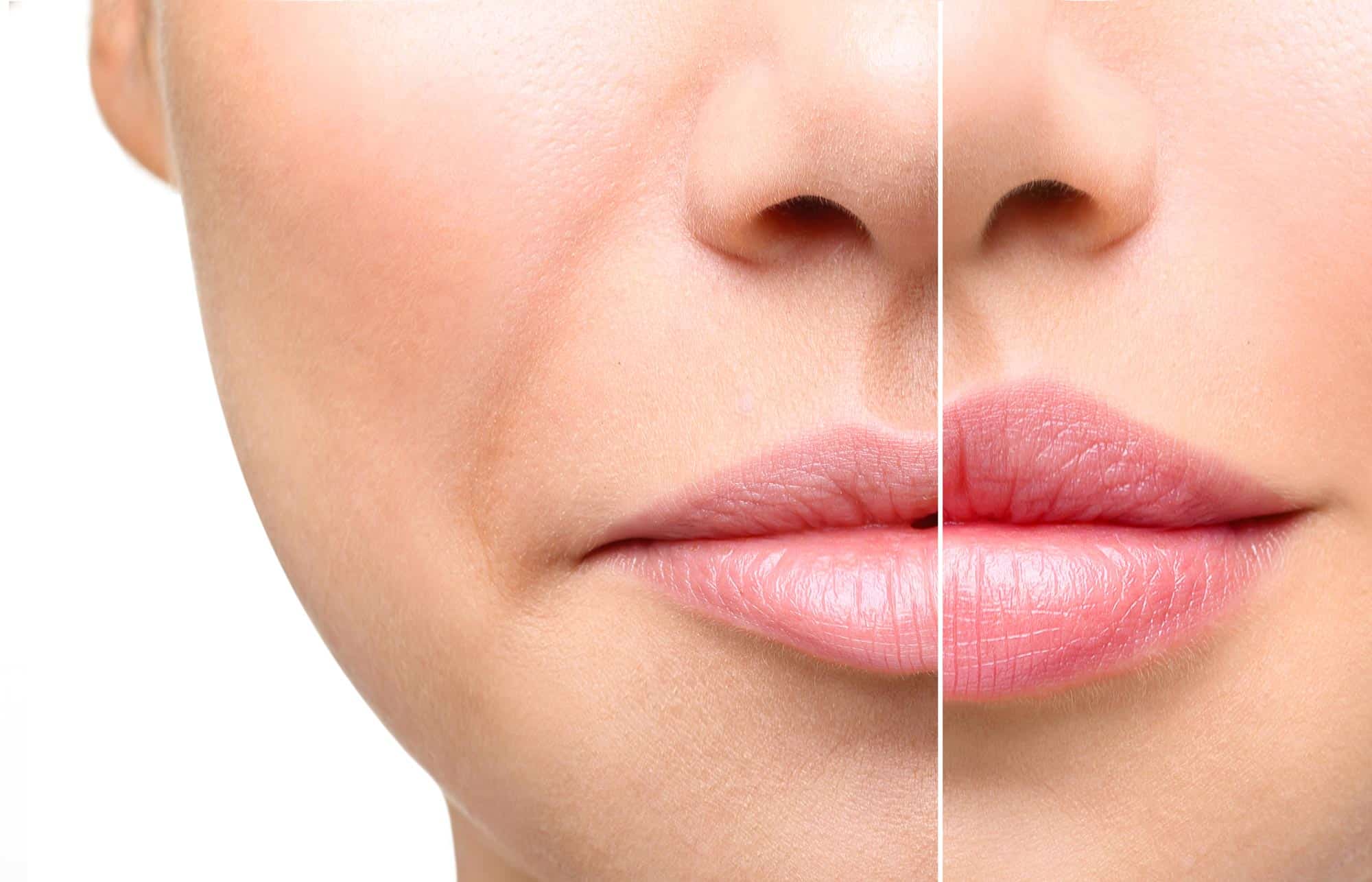 Lip-Filler-Dublin-3