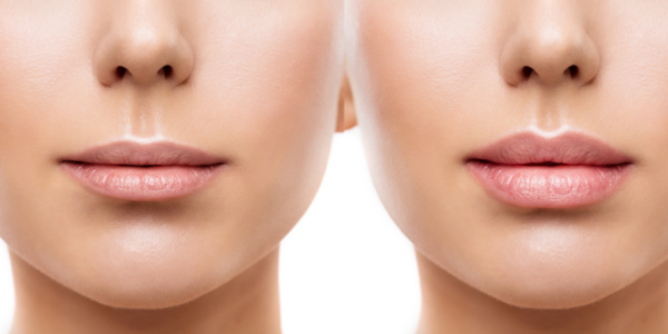 lip-injections-before-and-after-1