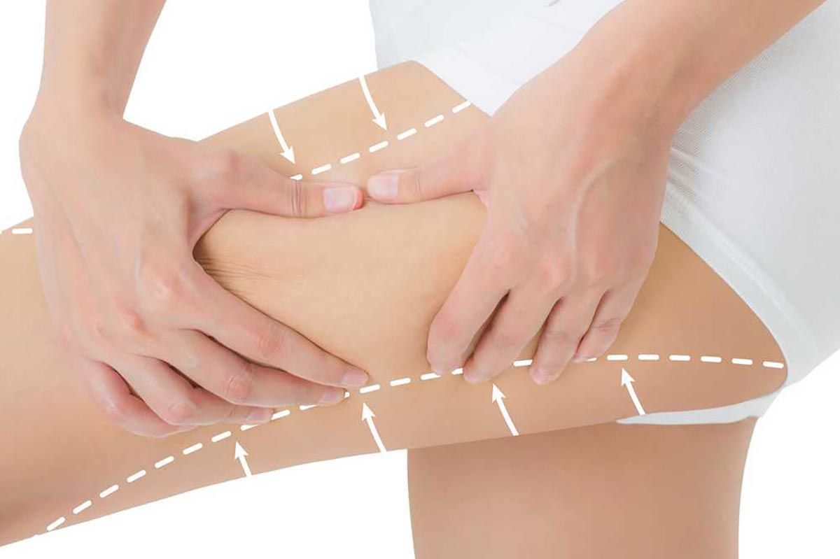 Liposuction-1