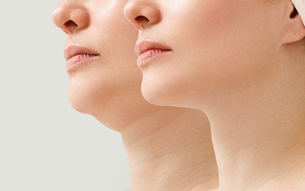 chin-suction