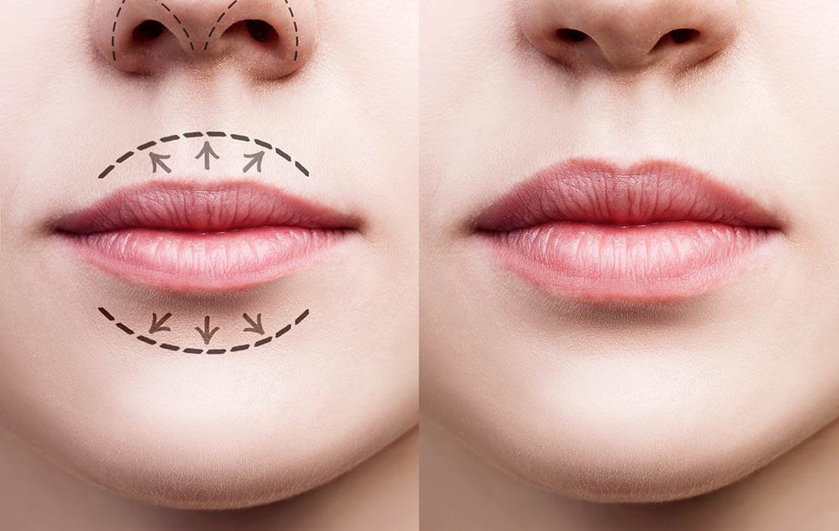 lip-lift-surgery-5