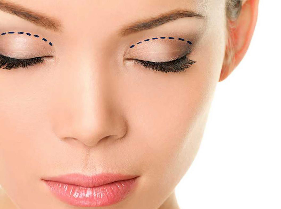 blepharoplasty surgery 4