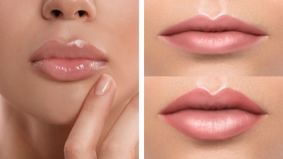 lip-filler-3-image